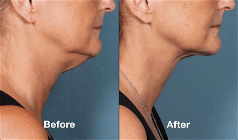 Kybella Injections Swelling Recovery | Beverly Hills | Los Angeles CA