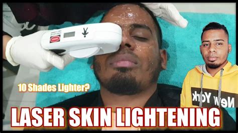 Laser skin lightening|10 Shades Lighter? I tried laser skin brightening ...