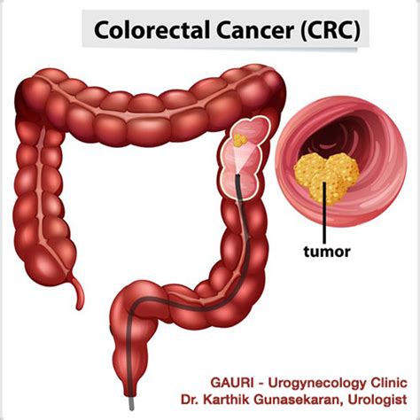 Colon (Colorectal) Cancer – Symptoms & Diagnosis | GAURI - Urogynecology Clinic