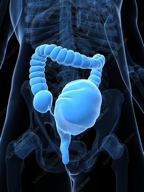 Toxic megacolon, artwork - Stock Image - F006/2539 - Science Photo Library