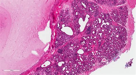 Mucocele Histology