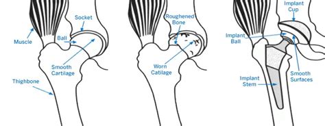 How to Walk With a Cane After Hip Surgery | Self Health Care