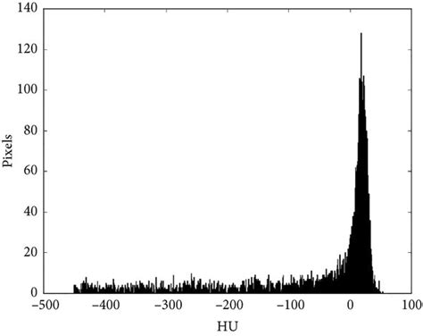 Histogram of a malignant nodule with a leptokurtic (i.e., resembling a ...