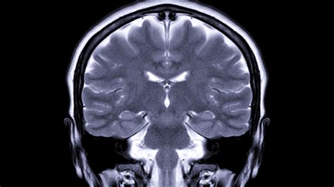 Brain Tumor Color Mri