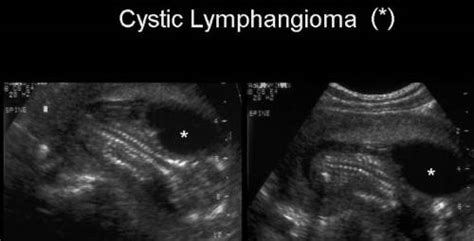 10 Facts about Cystic Hygroma | Fact File