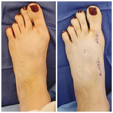 How long is recovery after having bunion surgery?