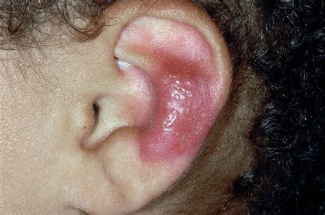 Herpes Simplex Lesion On The Ear Photograph by Dr P. Marazzi/science ...