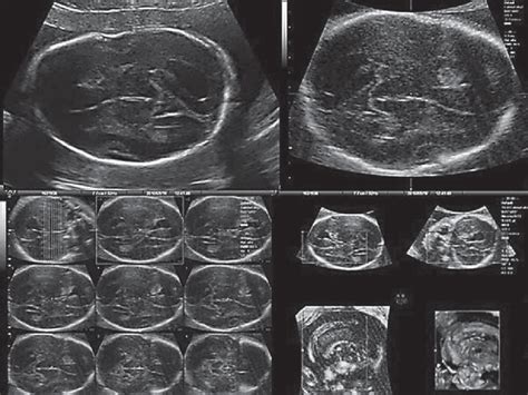 Case 2: 2D and 3D fetal brain ultrasound showing marked ventricular... | Download Scientific Diagram