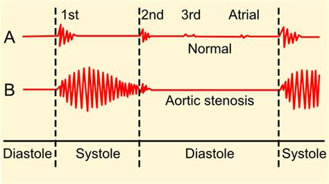 Aortic Stenosis Murmur