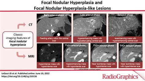 Focal Nodular Hyperplasia and Focal Nodular Hyperplasia–like Lesions ...