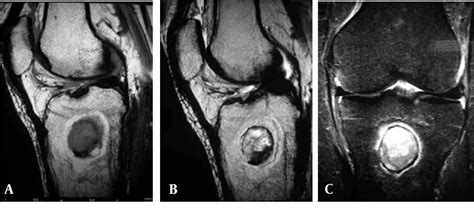 [PDF] The “Penumbra Sign” on Magnetic Resonance Images of Brodie’s Abscess: A Case Report ...