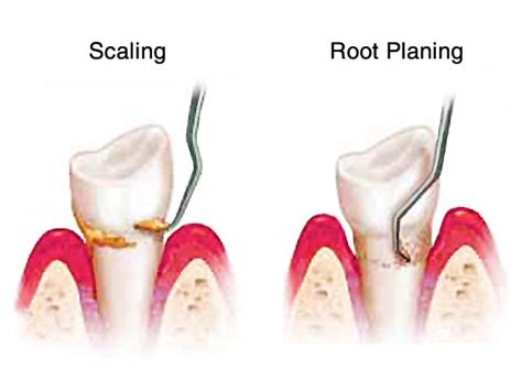 scaling-and-root-planing | Cox and Patel, DDS