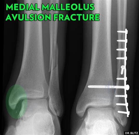 5 Kinds of Medial Malleolus Ankle Fractures