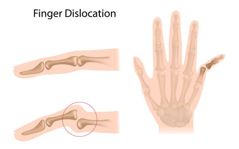 Hand and Finger Dislocations: Causes, Symptoms, and Treatment