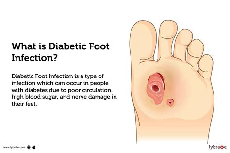 Diabetic Foot Infection: Causes, Symptoms, Treatment and Cost