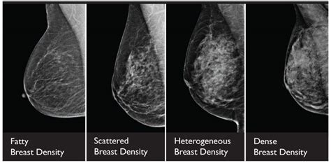 What Does It Really Mean To Have Dense Breasts? | Wake Radiology