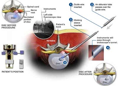 YESS Selective Endoscopic Discectomy™ - Florida Spine & Orthopedics