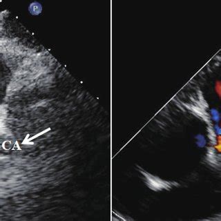 ALCAPA detected by echocardiography. Female, 37 years old, adult-type ...