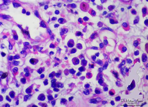 A case of Plasma cell gingivitis occurring in an 11 year old female patient that had underwent a ...