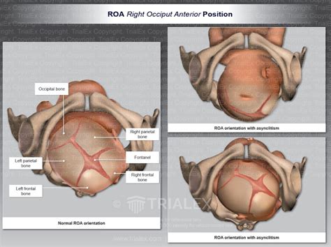 ROA (Right Occiput Anterior) Position - TrialExhibits Inc.