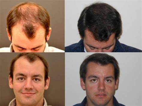 Hair Restoration | Austin, Houston and Dallas TX | Hair Transplantation | Hair Regrowth Therapy