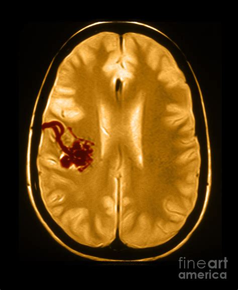 Mri Of Arterial Venous Malformation Photograph by Medical Body Scans - Fine Art America