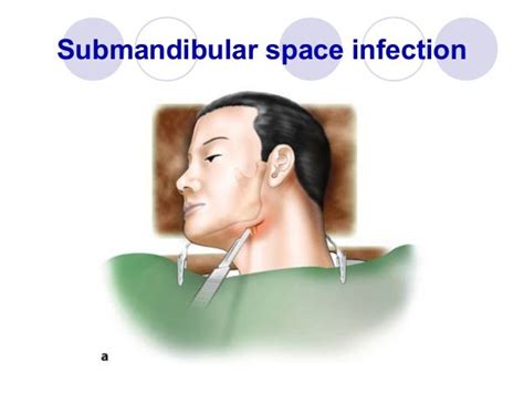 Oral and maxillofacial spaces of infection