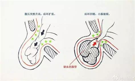 儿童睾丸疝气症状图片,儿童疝气症状图片,儿童疝气症状_大山谷图库