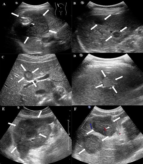 Conventional Ultrasound and Contrast-Enhanced Ultrasound in Hepatic ...