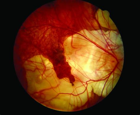 Clinical photography - Myopic degeneration | Spectrum