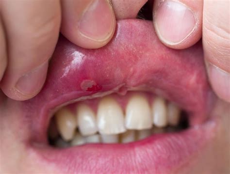 Mouth sores: Causes, treatment, and pictures