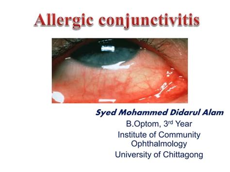 Allergic conjunctivitis | PPT