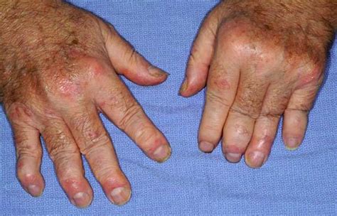 Psoriatic Arthritis - Causes, Symptoms, Diagnosis, Diet & Treatment