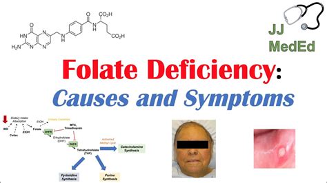 Folate Deficiency, Causes (ex. medications), Pathogenesis, Symptoms, Diagnosis and Treatment ...