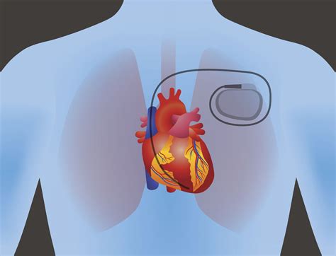 When Is a Pacemaker Needed for Heart Block?