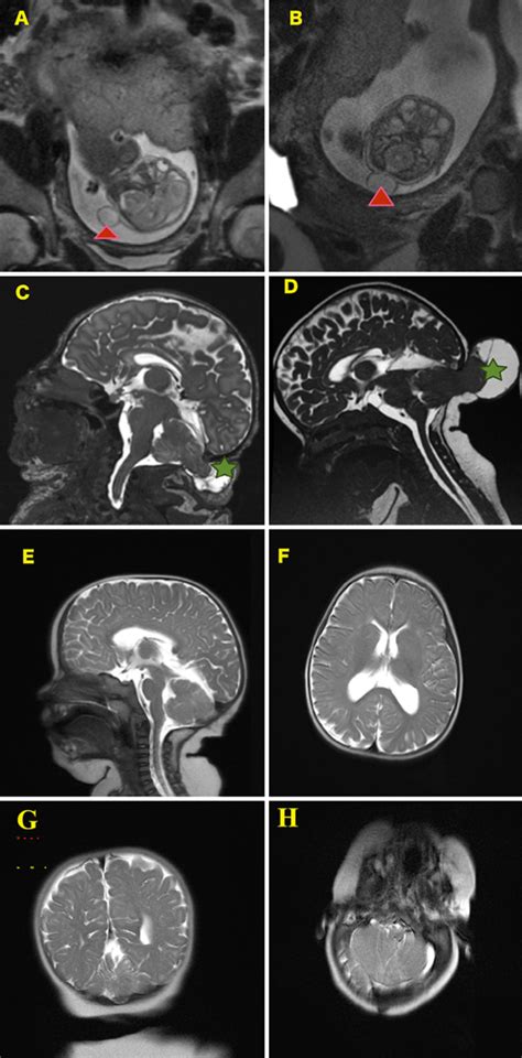 A: Sagittal prenatal MRI view of suboccipital meningocele at 21 weeks'... | Download Scientific ...