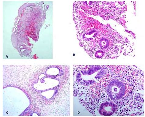 Endometriosis. A, Presence of endometrial-type glands set in an... | Download Scientific Diagram