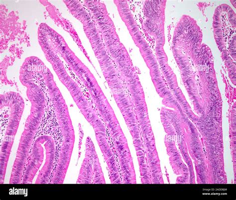 Villous colon polyp, light micrograph. This specimen shows tissue from ...