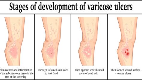 Venous Stasis Leg Ulcer - Ulcer Choices