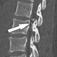 A CT scan of the lumbar spine (sagittal view). Arrow pointing toward... | Download Scientific ...