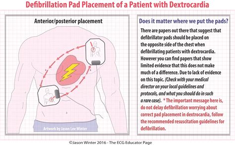 ECG Educator Blog : Dextrocardia