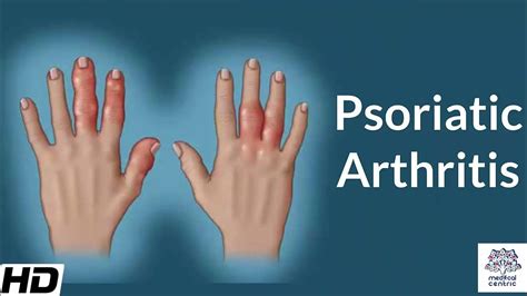 Psoriatic Arthritis, Causes, Signs and Symptoms, Diagnosis and Treatment. - YouTube