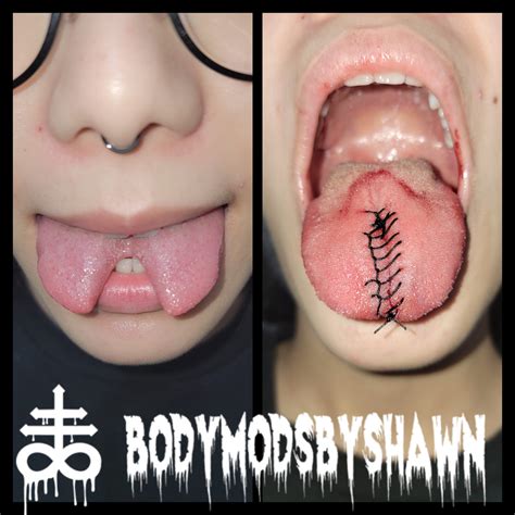 Tongue Split Reversal - Body Mods by Shawn