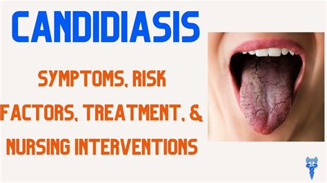 CANDIDIASIS SYMPTOMS, Risk Factors, Treatment, & Nursing Care - YouTube