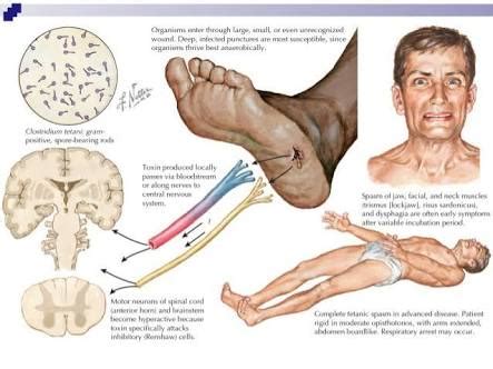 Oral Polio Vaccination not for all paralysis prevention & Tetanus Toxoid not for all infection ...