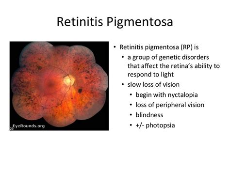 Nw2016 retinitis pigmentosa