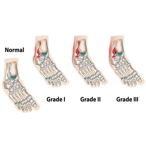 Ankle Sprain Grades