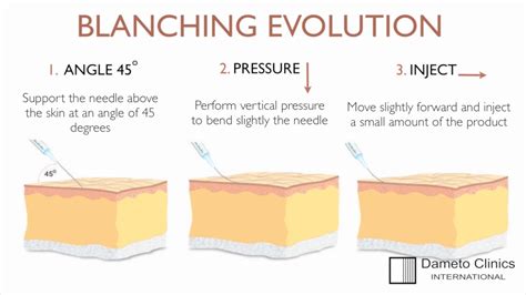 Dr. Gabriel Siquier "blanching evolution" technique at Dameto Clinics ...