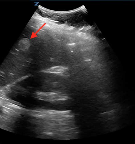 Ultrasound Liver Rounds! — Staten Island University Hospital Emergency Medicine