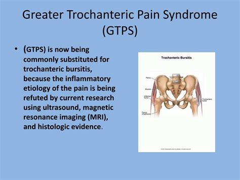 PPT - Greater trochanteric pain syndrome (GTPS), also known as ...